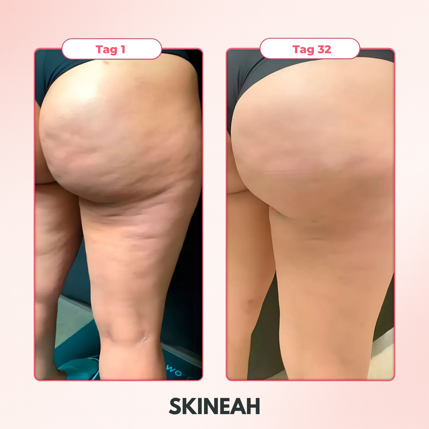 Skineah - Anti Cellulite Massager