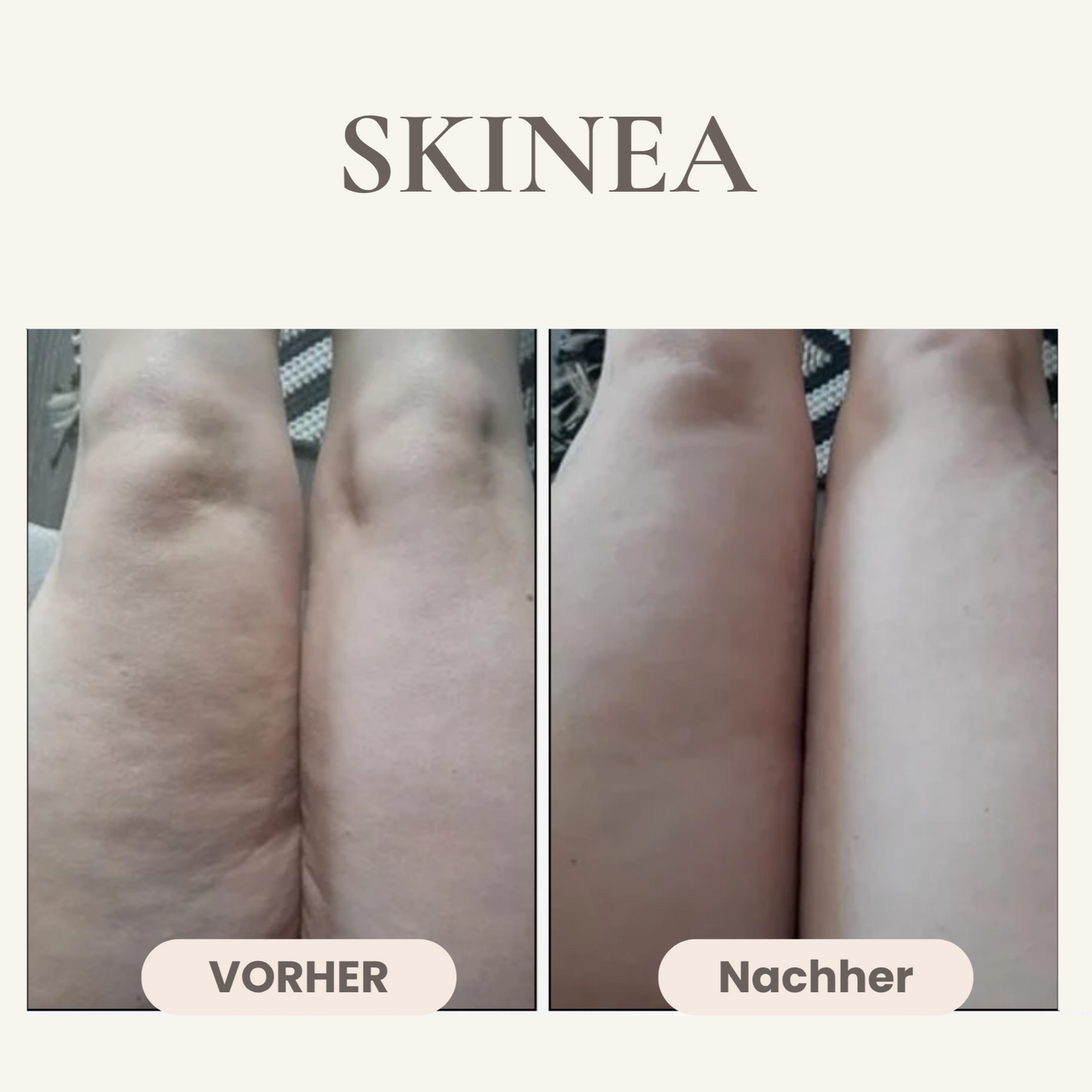 Body Gua Sha - Cellulite Frei in 30 Tagen
