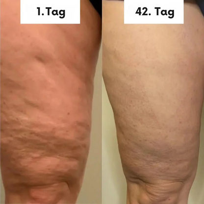 Skineah - Anti Cellulite Massager